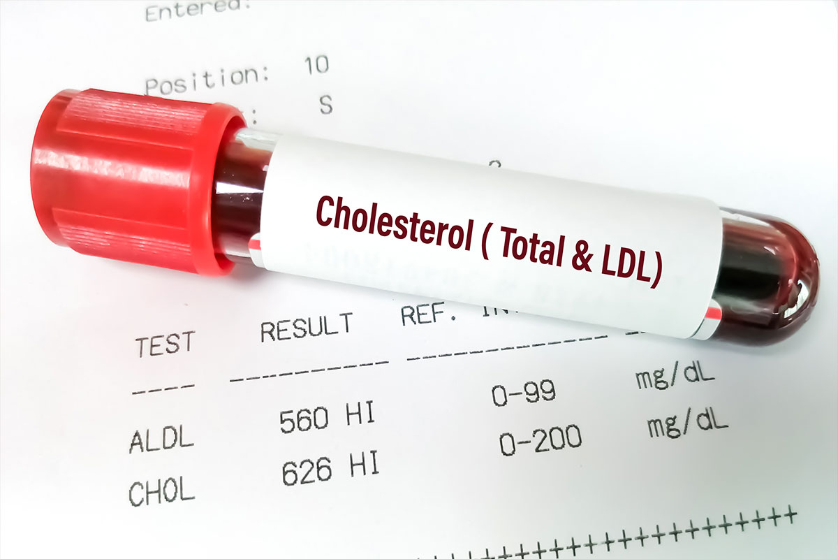 High Cholesterol Specialist in Detroit, Michigan